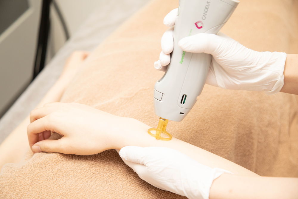 医療レーザー脱毛の料金や施術内容｜静岡の美容皮膚科・美容外科なら