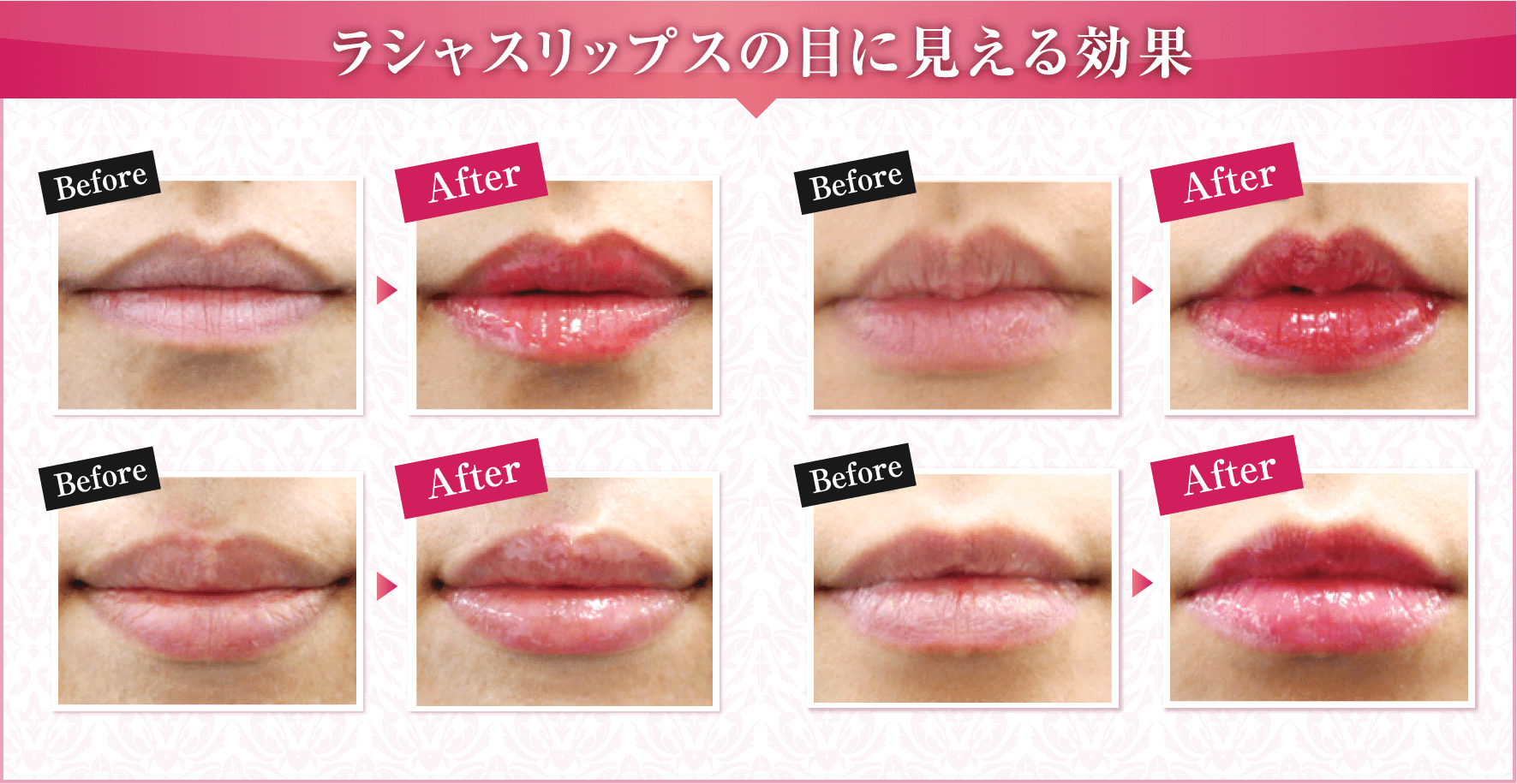 LusciousLips ラシャスリップス｜セントローズクリニック