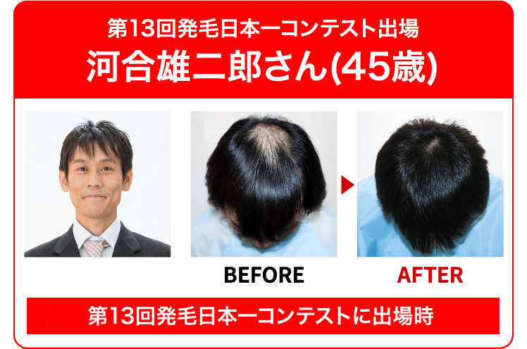 薄毛改善・発毛専門リーブ21 85.28%のお客様の抜け毛が減少 実感できる
