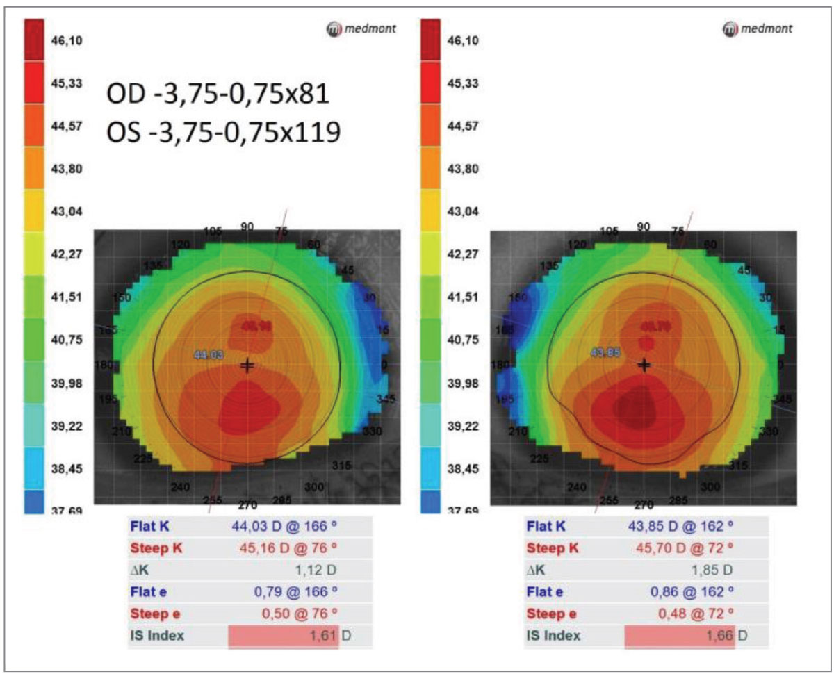 Consider These Elements When Fitting Ortho-K Candidates