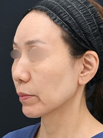 脂肪吸引なら湘南美容クリニック【公式】｜美容整形・美容外科