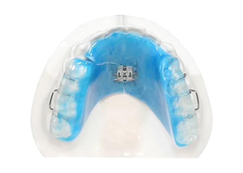 矯正装置の種類｜大阪府枚方市の辻村矯正歯科