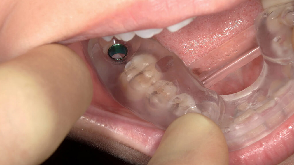 インプラント治療｜門前仲町・木場の歯医者【門前仲町髙木歯科】