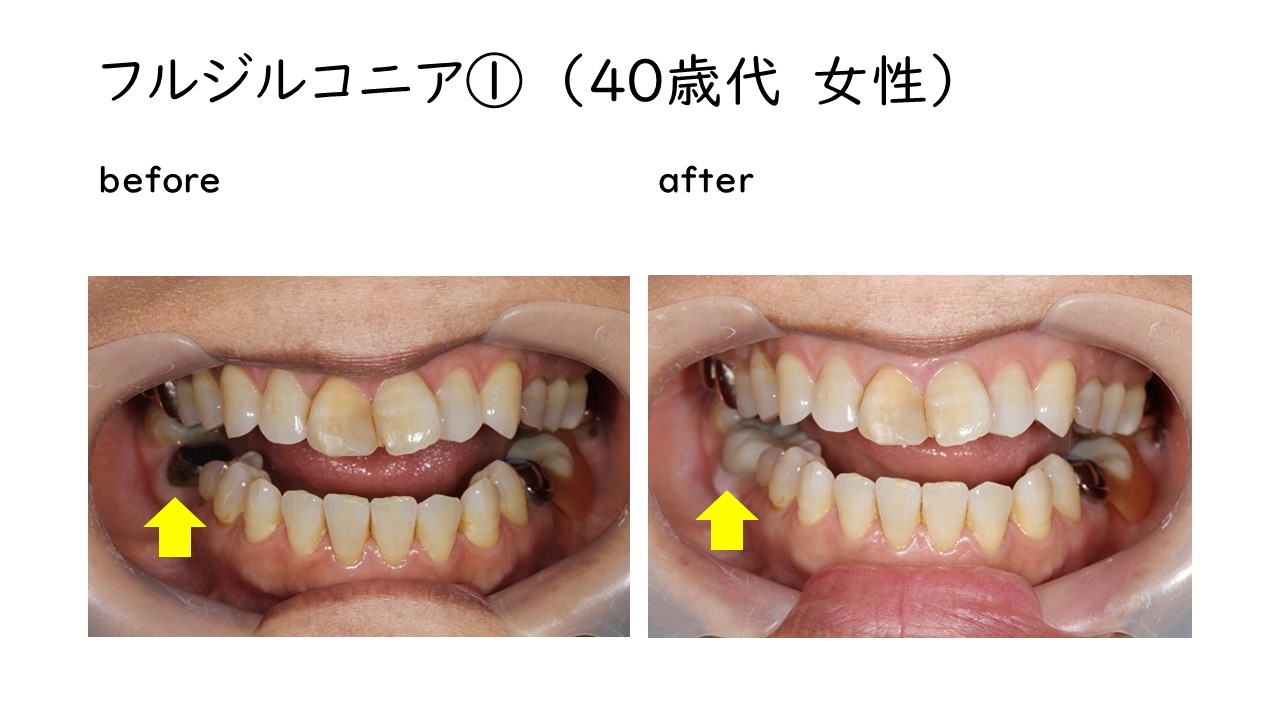 フルジルコニアクラウン | 山口県下松市の宇都宮歯科医院。きれいな