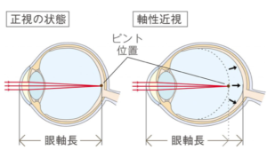 マイオピン（0.01％アトロピン）治療について | スカイビル眼科【公式】