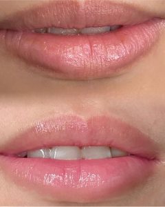 ローマピンク–エックスクリニック｜X CLINIC｜ エイジングケア・クマ