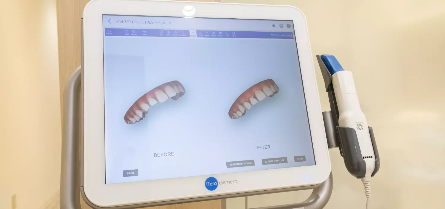 iTero」インビザライン 対応口腔内スキャナ― - JR秋葉原駅より徒歩5分