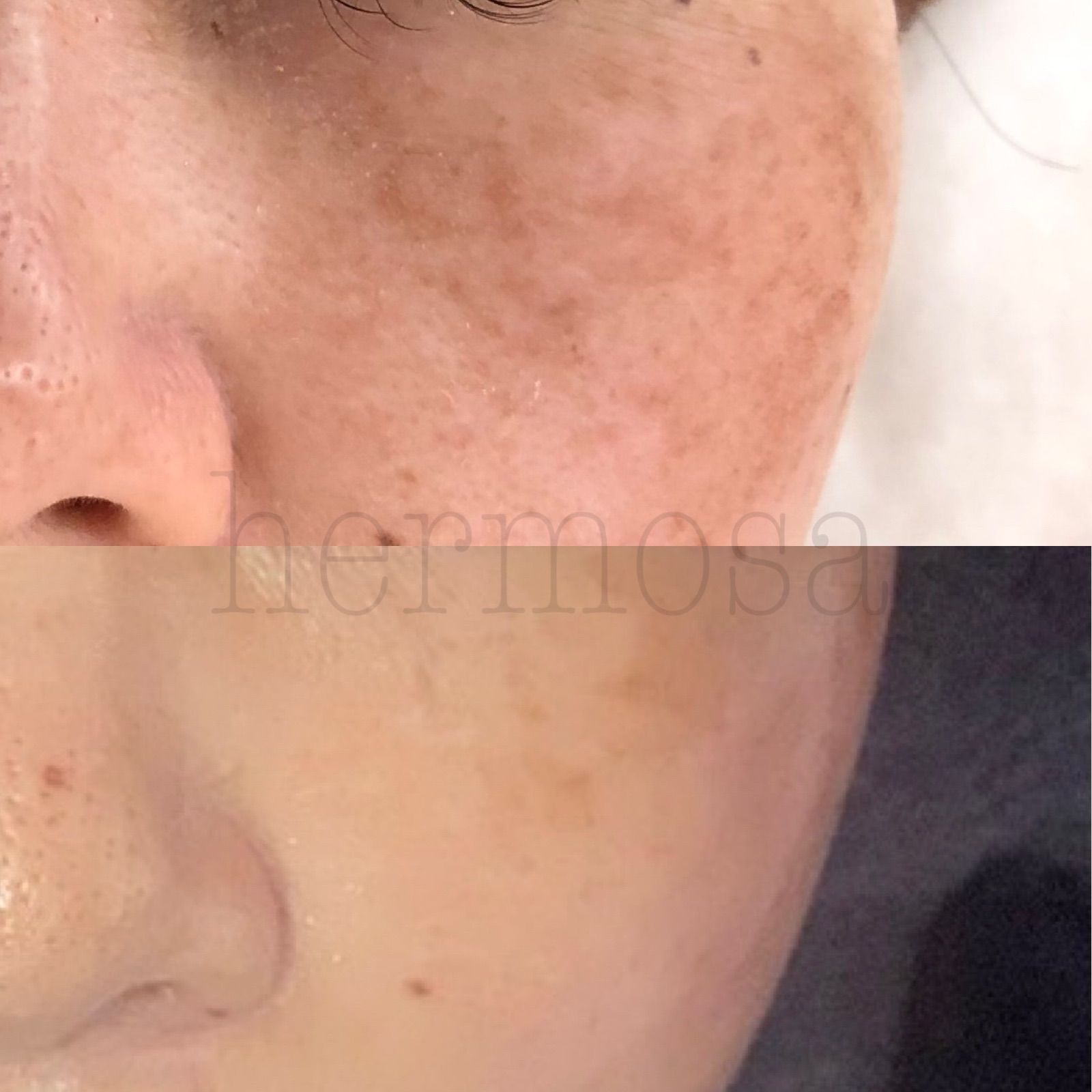 エルモサ スノーインテンシブスティック(シミ用美容液) ライト(昼用