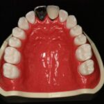 患者様説明用模型 – 【公式】広島市の歯科技工所「株式会社アート