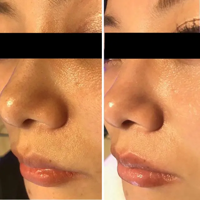 ハイドラフェイシャル治療 | Beauty Tuning Clinic