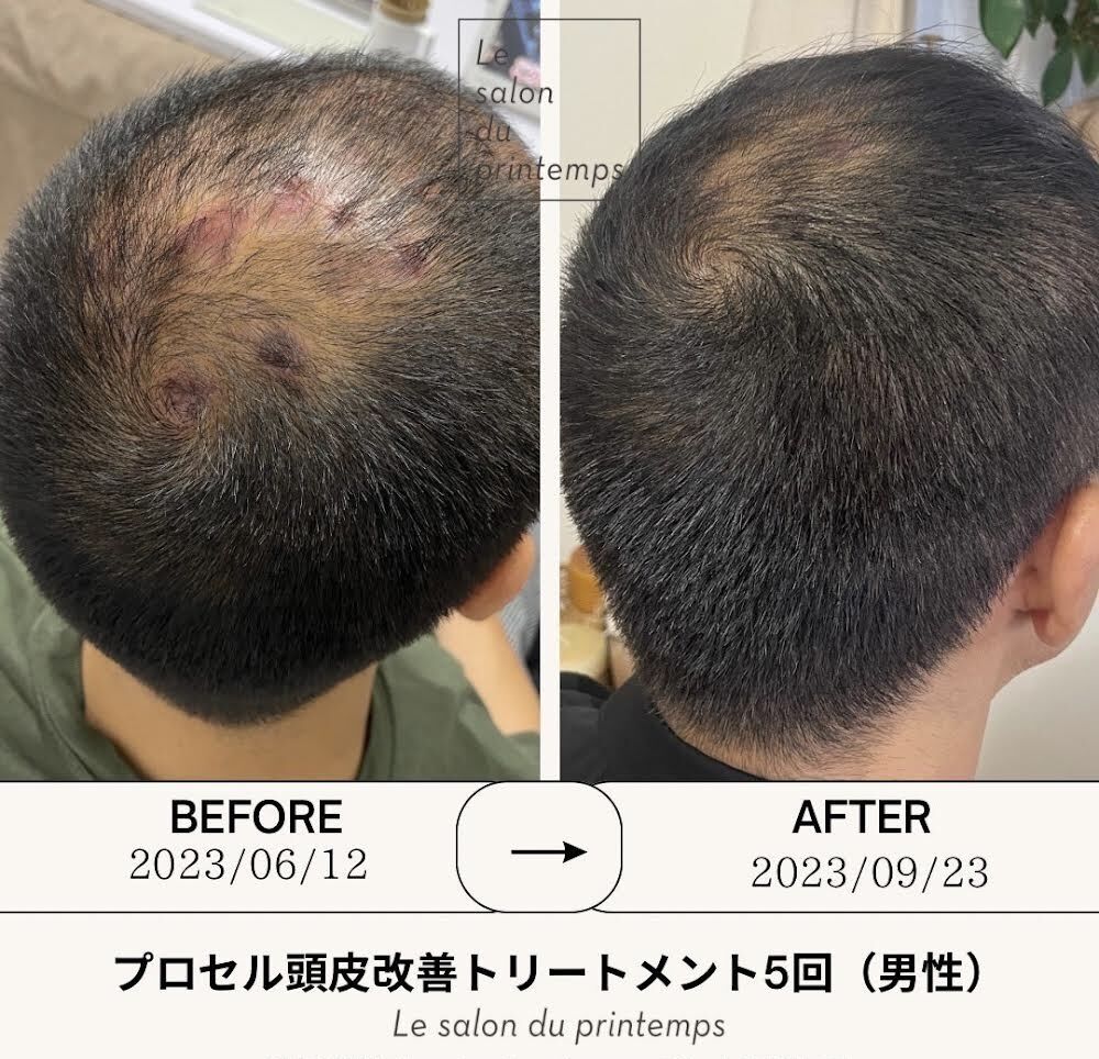 プロセルセラピーズで薄毛育毛を！ 《横須賀市》美顔美療Labo | コラム