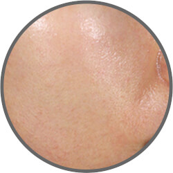 医療機器メーカーが提案する「サブマイクロ波RF美顔器」NEWAリフト