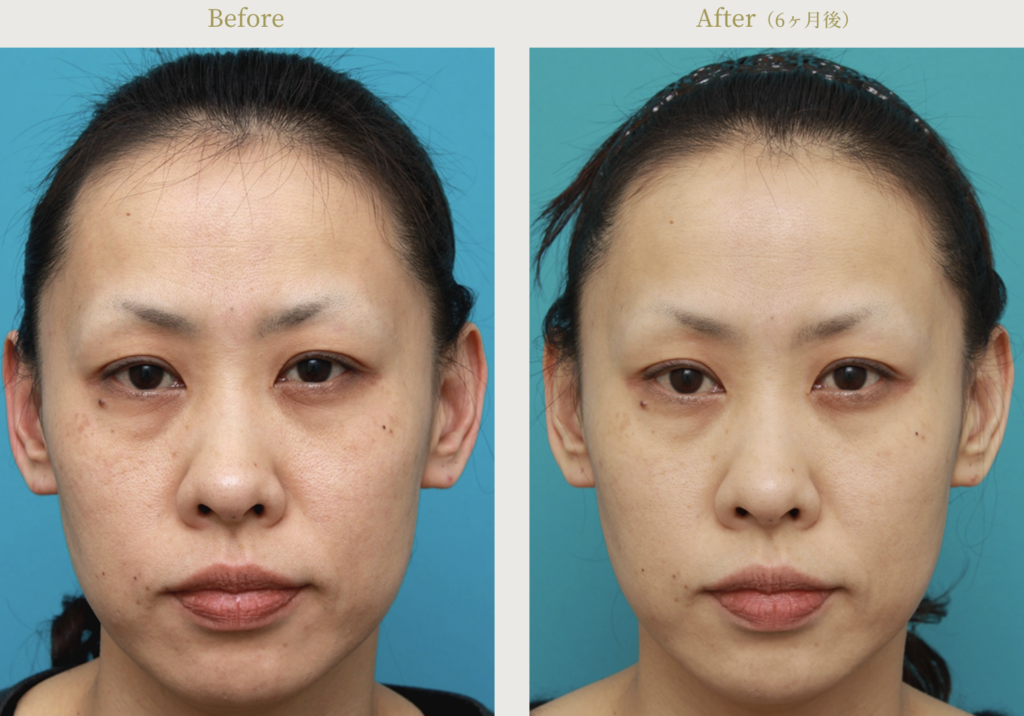 高須クリニックの糸リフトの口コミ評判は？人気のイタリアンリフトや金