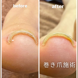 NEW】巻き爪でお悩みの方へ『レジスタンスプレート（巻き爪施術
