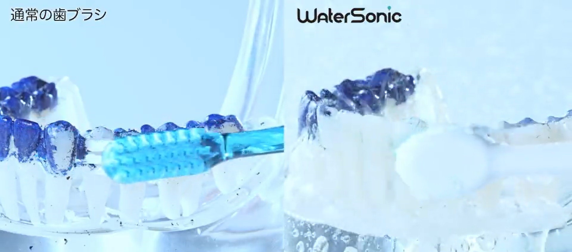 高圧のジェット水流と音波振動で歯周ポケットの汚れまで落とすスフォー