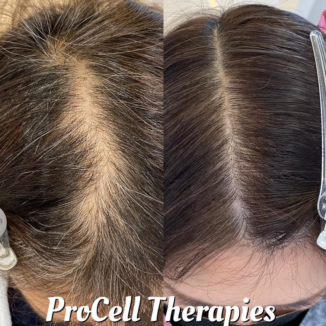 プロセルセラピーズ 頭皮用美容液 5ml×2本 2026年最新】プロセル