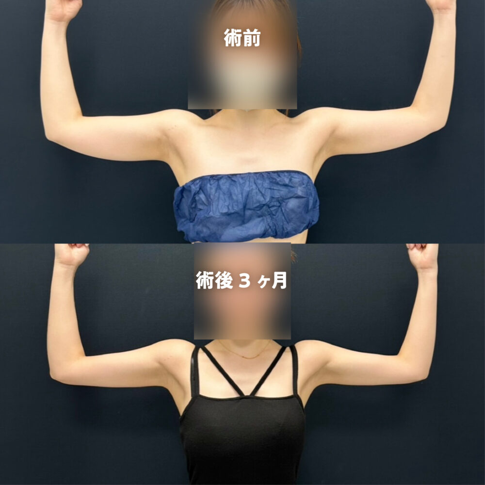 東京/二の腕の脂肪吸引名医】二の腕脂肪吸引を東京でするなら