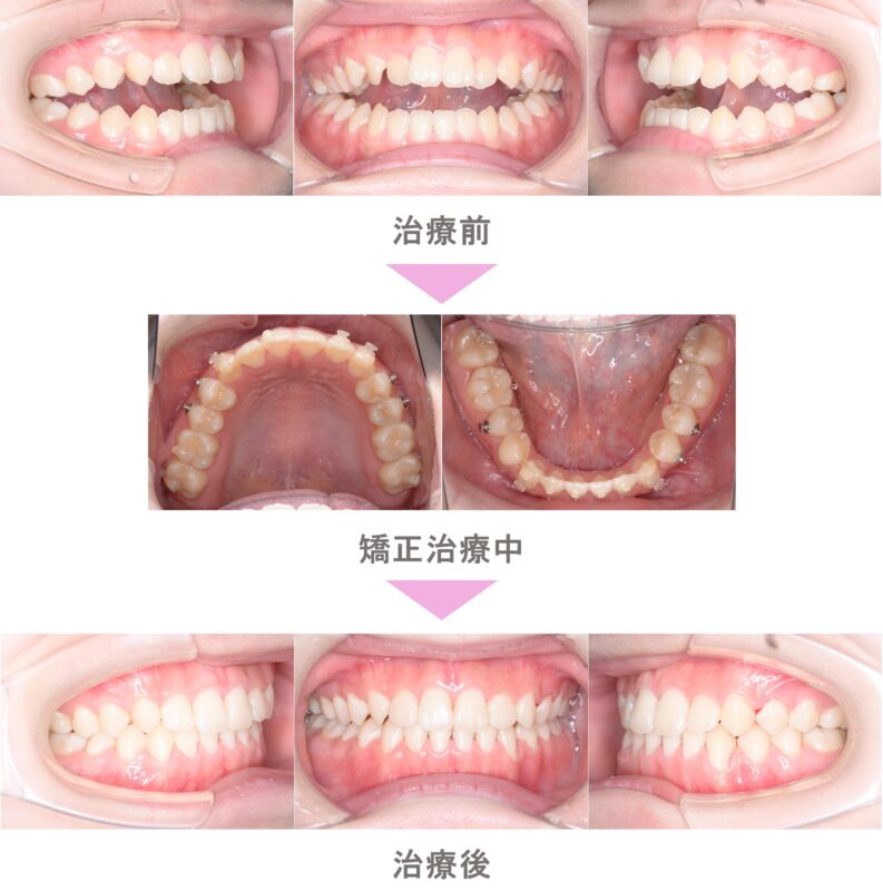 インビザライン矯正（マウスピース矯正）の症例紹介｜開咬（オープン