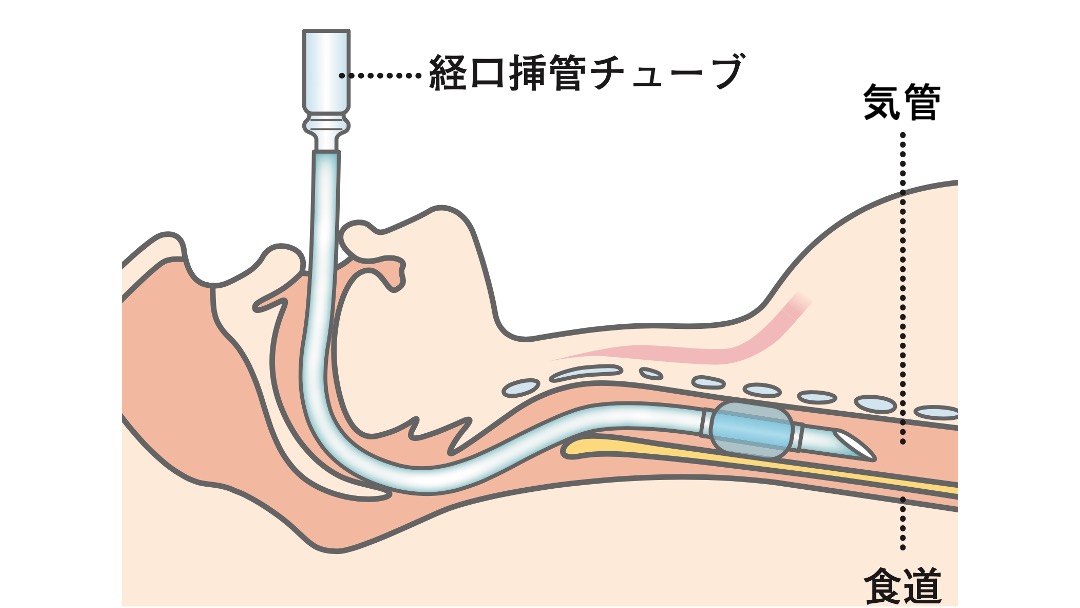第42回 じつは難しい人工呼吸 | Humony International