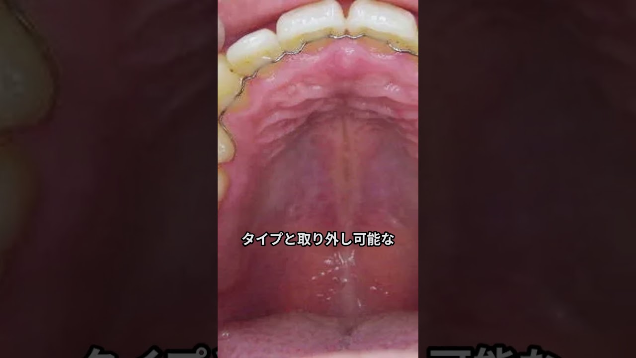 リテーナーとは？矯正治療後に欠かせない保定装置の役割と正しい使い方