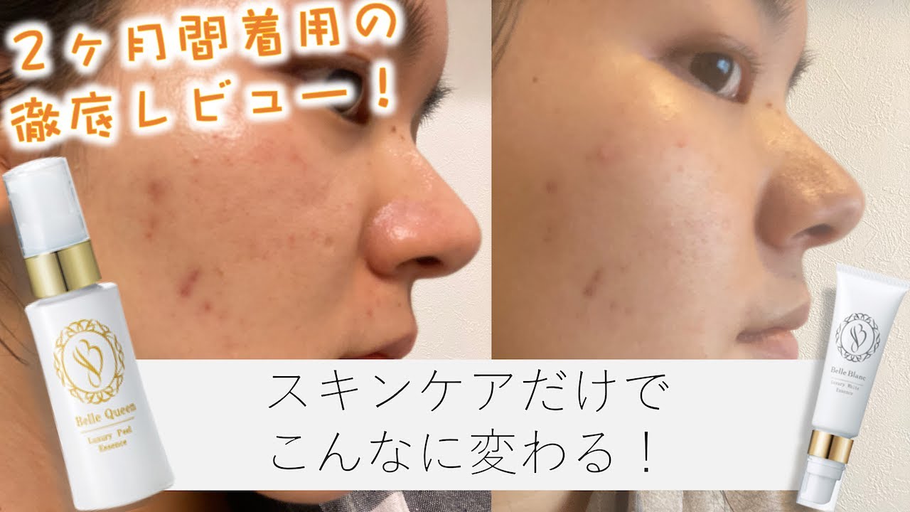 スキンケア】ニキビ跡が2ヶ月で消える！？ベルブランとベルクイーンを