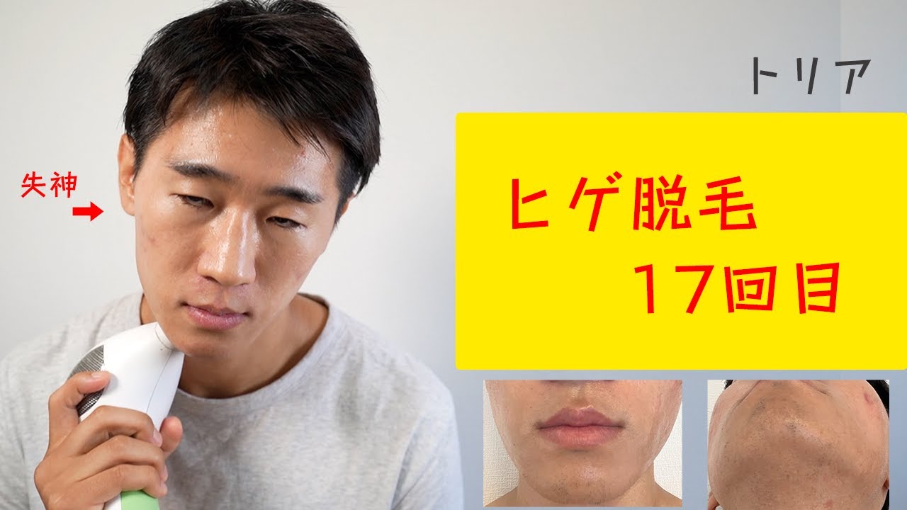 トリア 17回目 ヒゲ脱毛が順調すぎる理由はこれです。 - YouTube