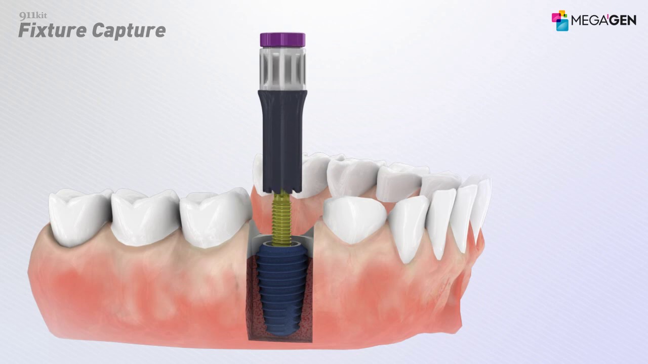 911kit｜製品情報｜株式会社メガジェンジャパン｜歯科用インプラント