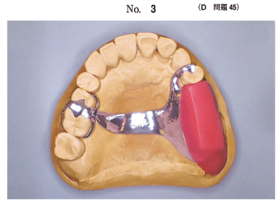 部分床義歯学：メタルフレーム（計14問）【歯科医師国家試験】（2020年