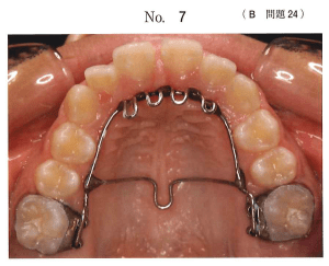 歯科矯正学：タングクリブ（計1問）【歯科医師国家試験】（2025年10月