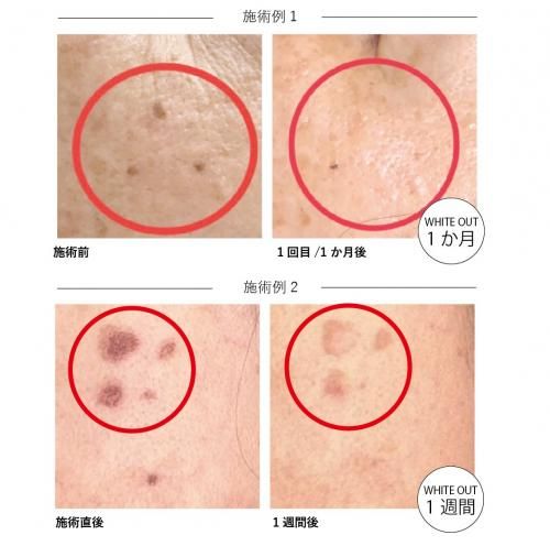 ザホワイトアウト(シミケアマシーン)専用美容液セット - 【公式