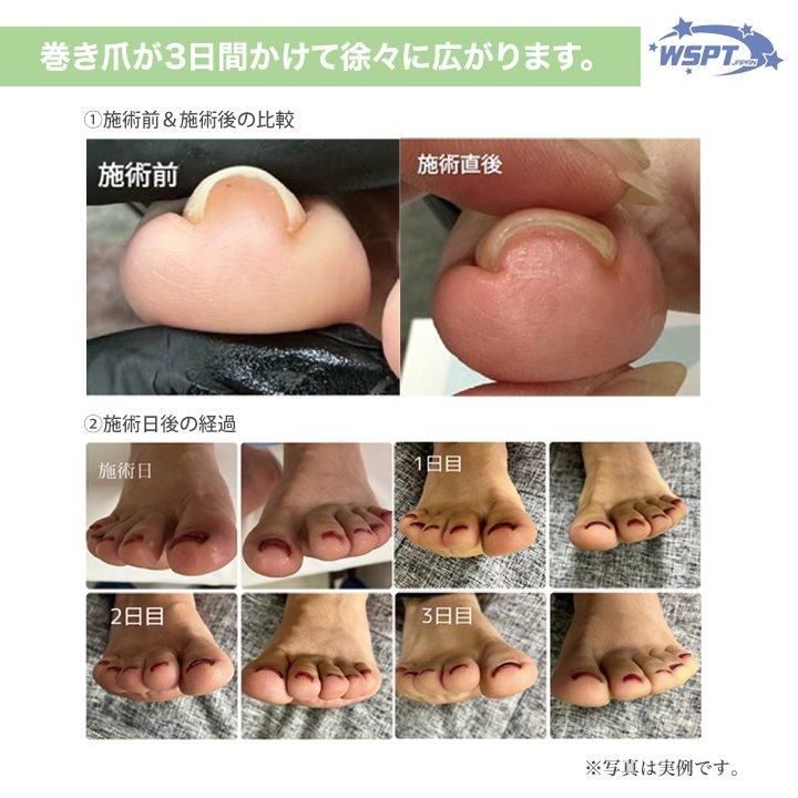 戸田先生おすすめ！】 巻き爪ケア フラットケアジェル 3本セット