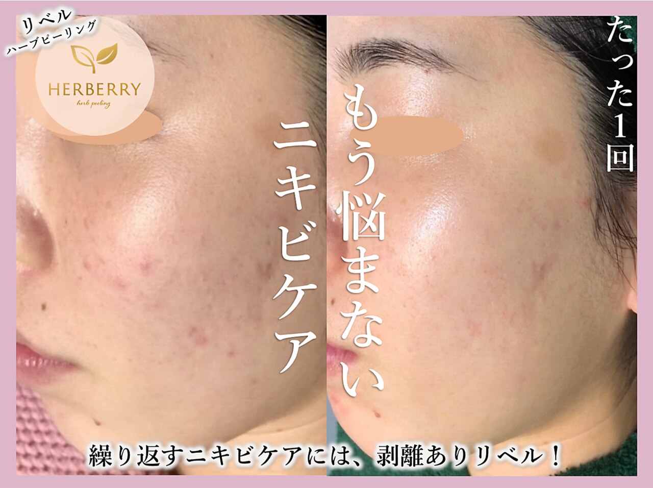 フォト｜ハーバリー ハーブピーリング 大阪梅田店(HERBERRYハーブ