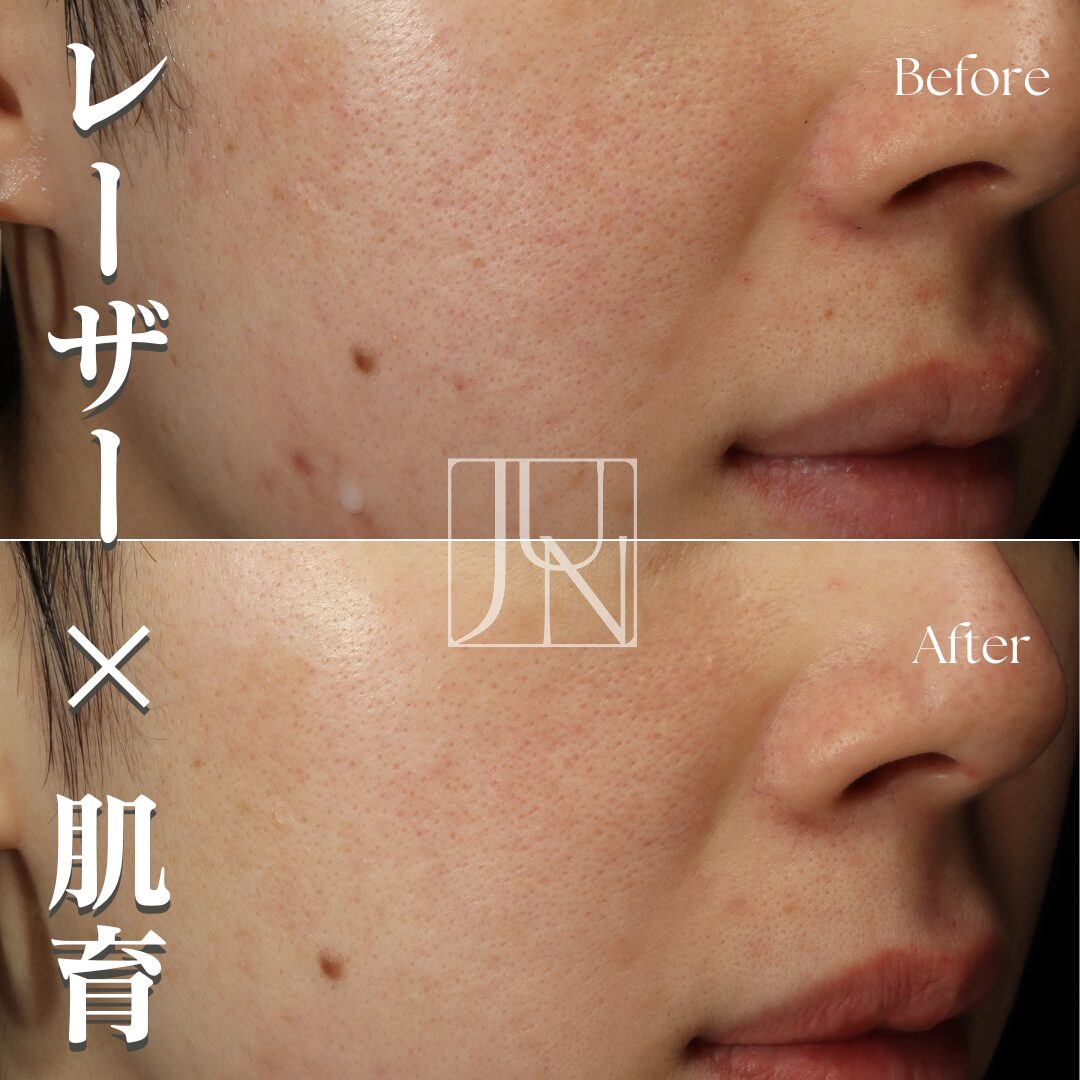 ニキビ跡、毛穴、しみ、そばかす 噂のNikki´s Skin Clear 通常版