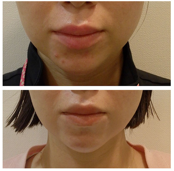 デュアリティークリーム使用3か月の変化 | 名古屋 金山の美容皮膚科