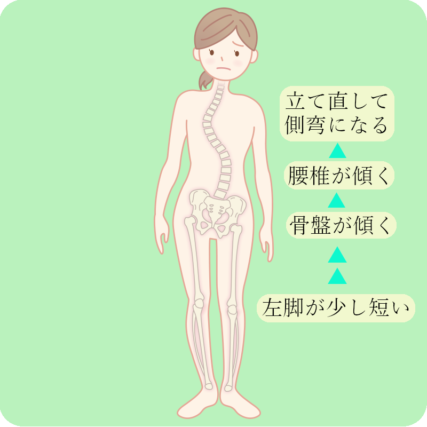 側弯症のための運動療法（シュロス法）を行っています | 滋賀県守山市