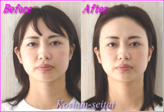 顔の左右非対称改善・左右の目の高さが揃いました/ お客様の声 - 札幌