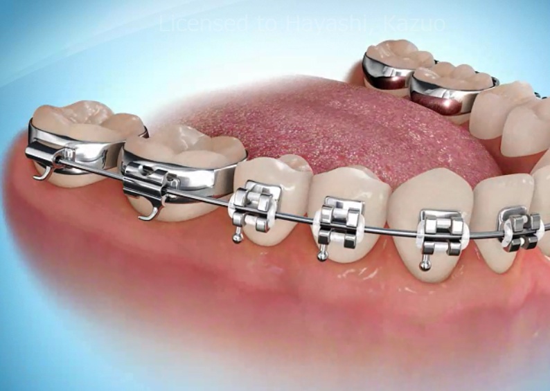 バンドタイプの矯正装置とセパレートについて - 【公式】日本橋はやし