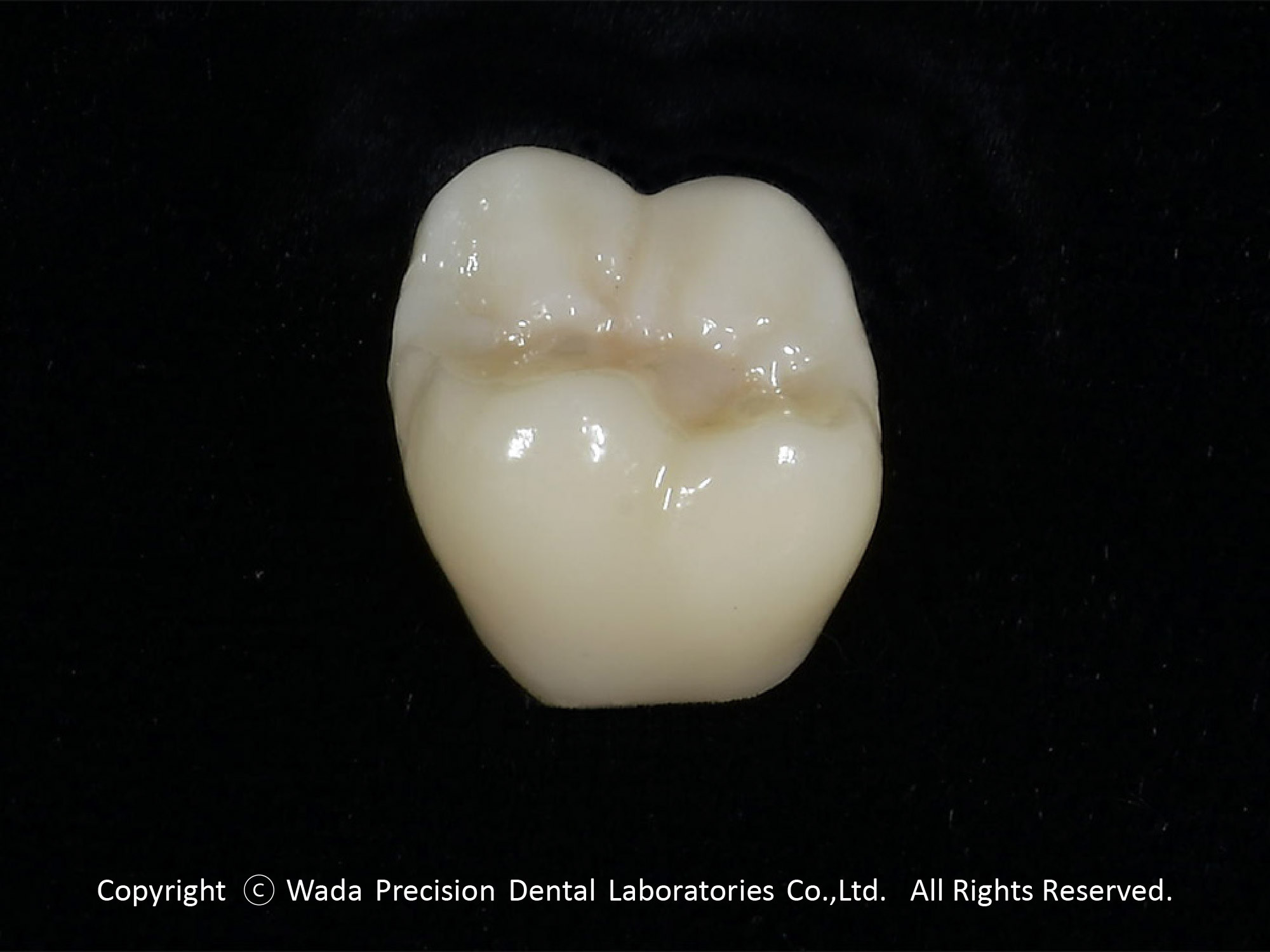 CAM美麗クラウン・チタン - 【公式】和田精密歯研株式会社