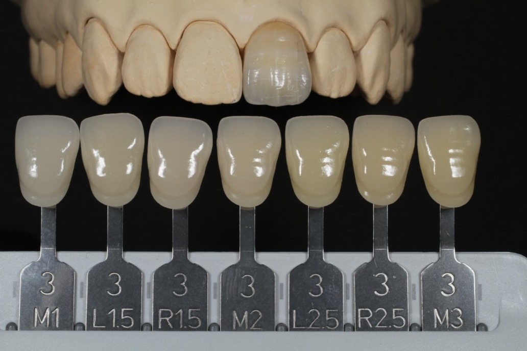 VITA-3Dマスターシェードガイドを使った『正しいシェードテイキング