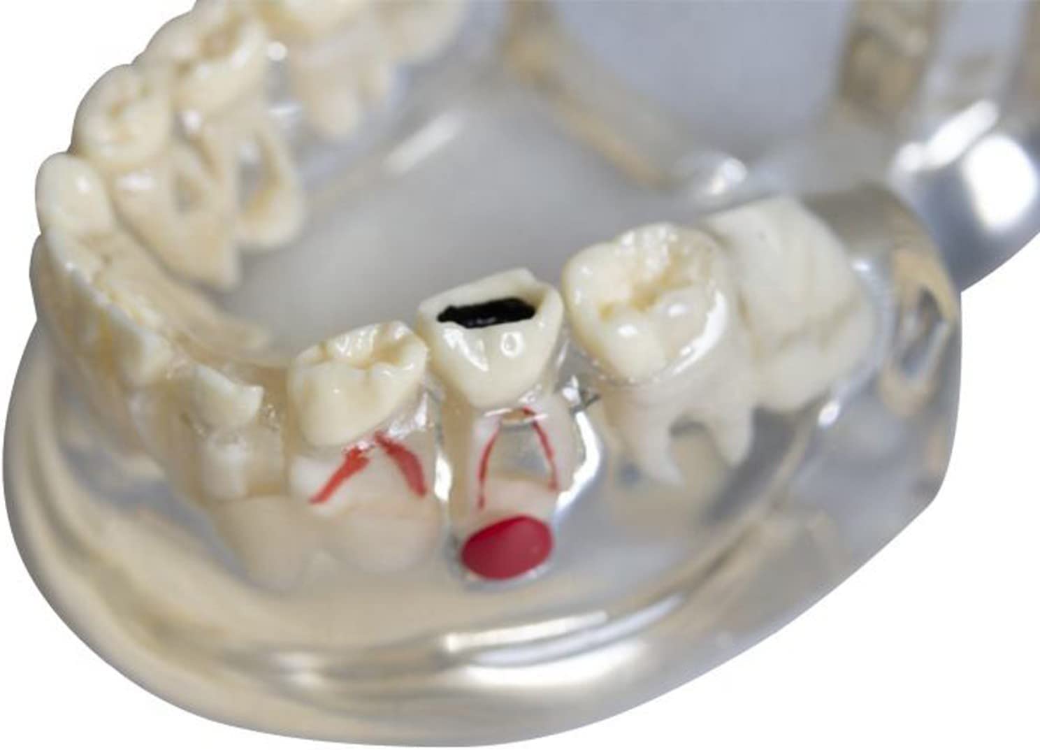 Amazon.co.jp: 歯列模型 子供の乳歯モデル子供の透明歯のモデル 乳歯と