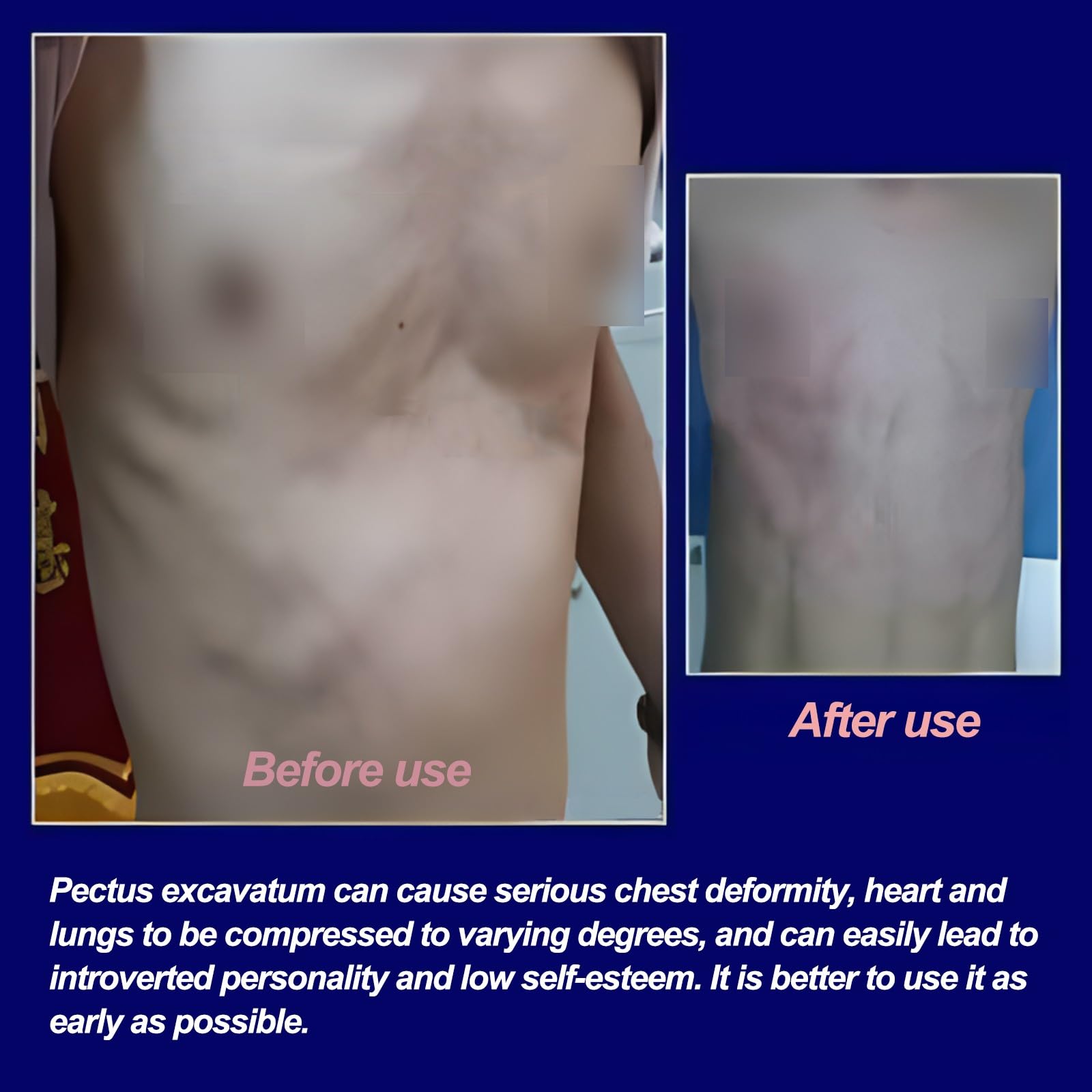 Amazon.co.jp: 10PCS 漏斗胸バキュームベル、漏斗胸装具ブレース、漏斗