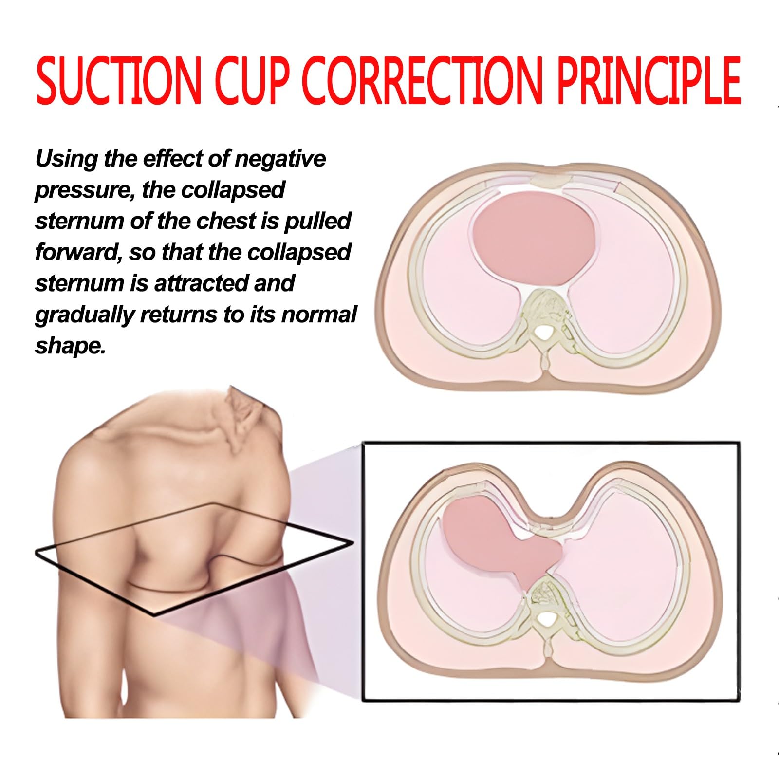 Amazon.co.jp: 10PCS 漏斗胸バキュームベル、漏斗胸装具ブレース、漏斗