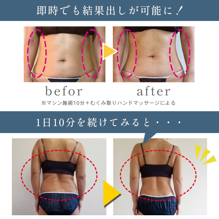 CAVI-R ONE＋|キャビテーション・ラジオ波・LEDでお腹・太ももを