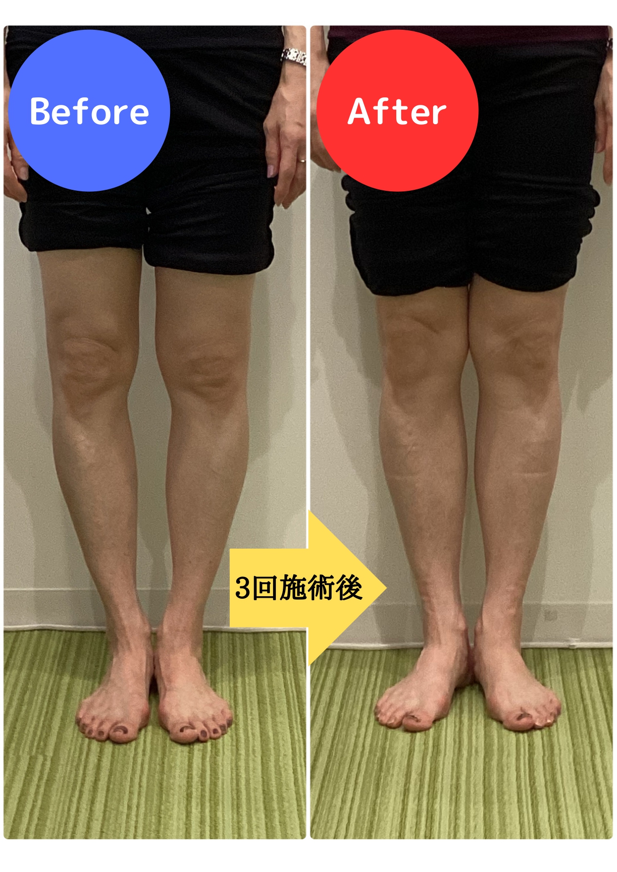 O脚矯正 | 駒沢大学駅から徒歩5分の整骨院！まつもと整骨院