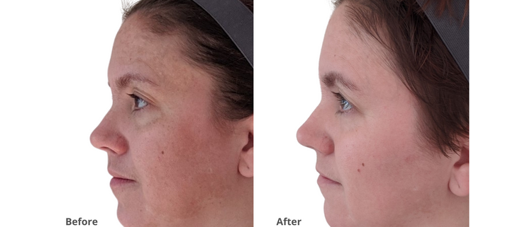 Hyperpigmentation – MD Complete Skincare