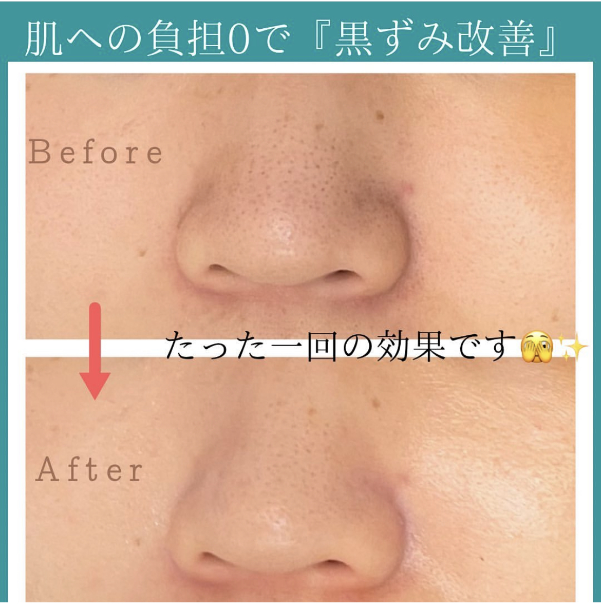 柏市】毛穴の黒ずみがたったの1回で綺麗に◎肌への負担0