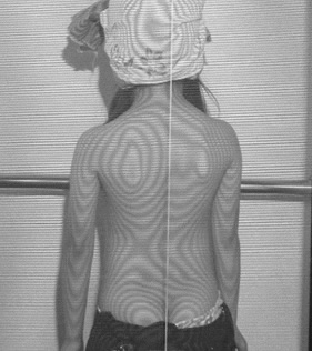 モアレトポグラフィー | 仙台で腰痛、ぎっくり腰、筋肉疲労の治療なら