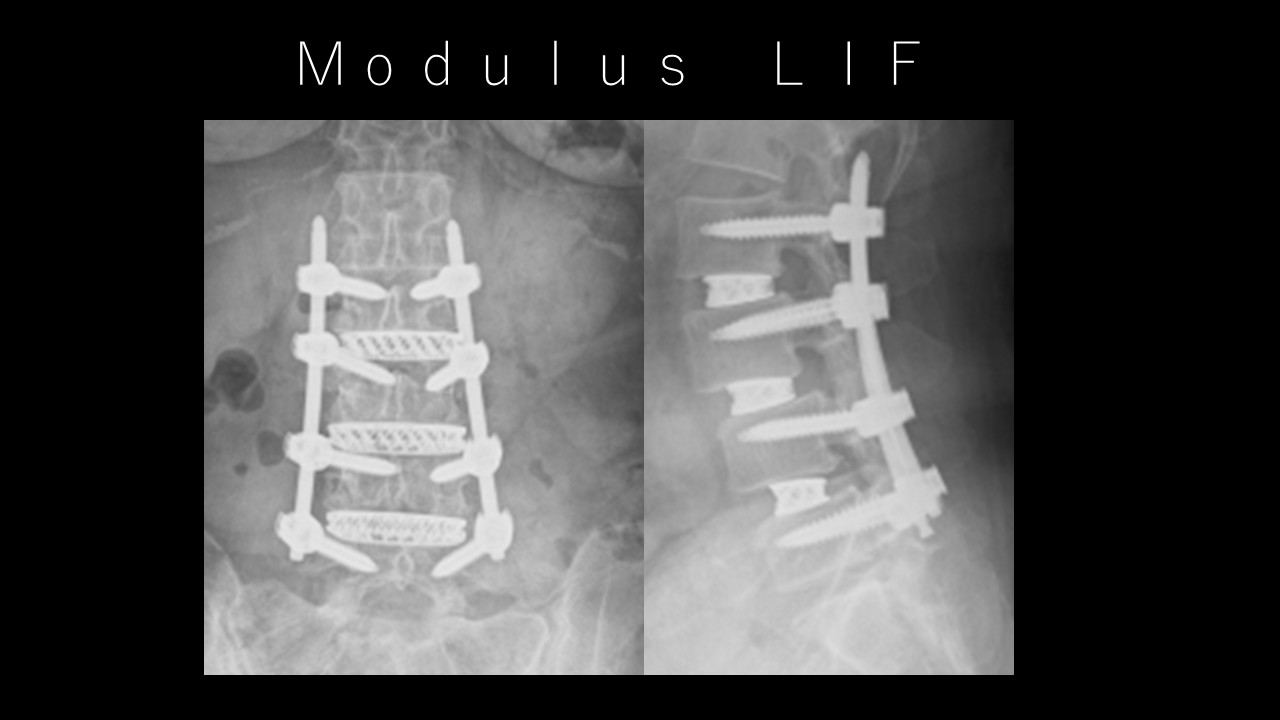 腰椎固定術の進歩！NuVasiveの3Dプリントチタンケージ「Modulus」で