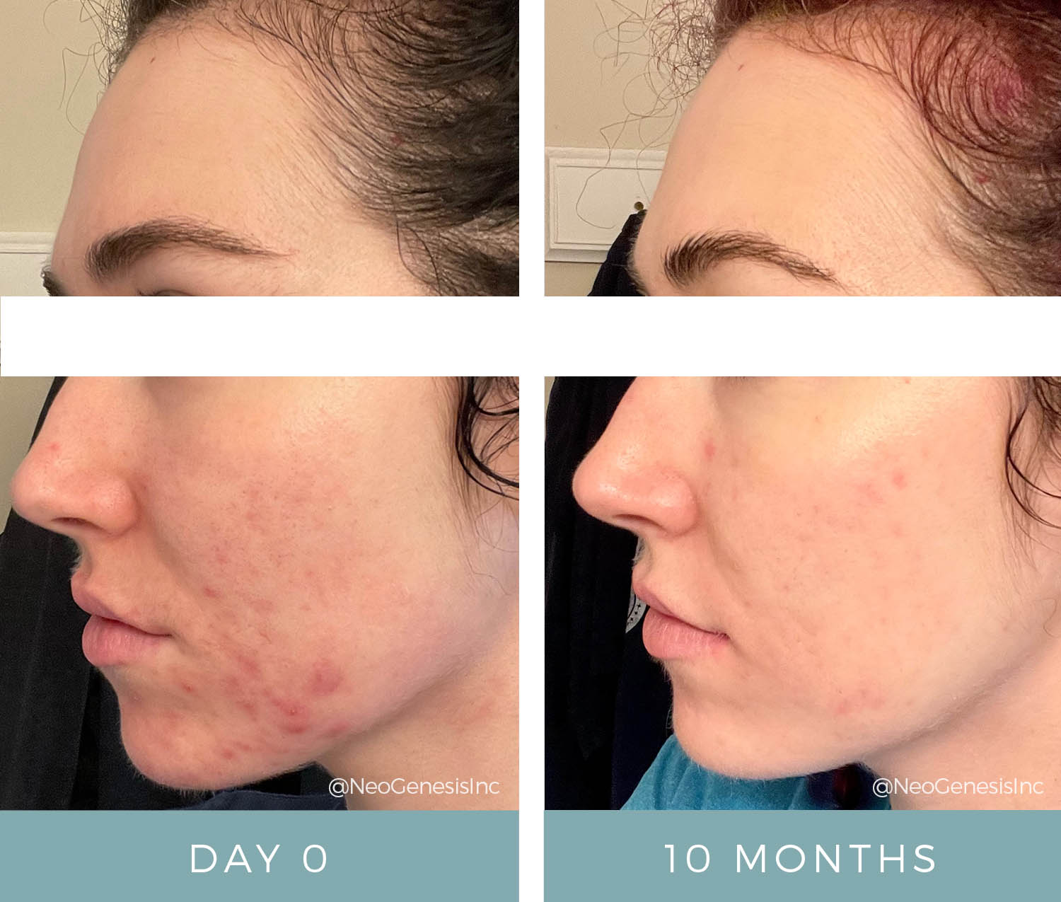 NeoGenesis Products and Microneedling for Hormonal Acne