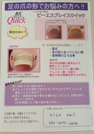 巻き爪でお困りの方へ、BSブレイスクイックのご紹介！